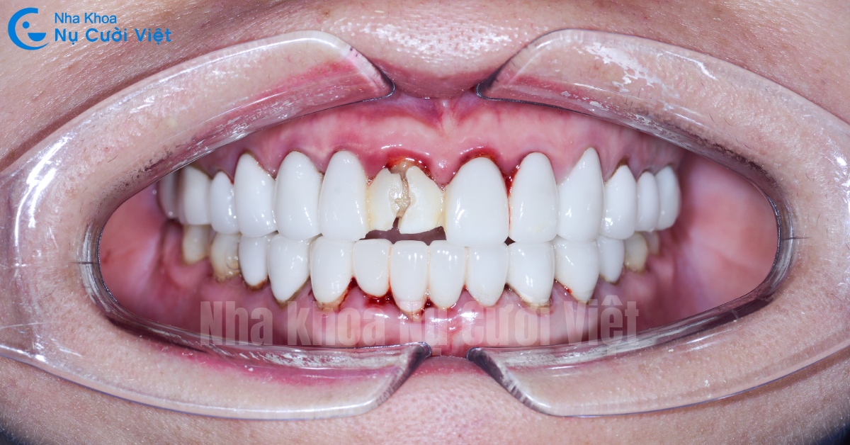 hậu quả bọc răng sứ giá rẻ gây gãy vỡ