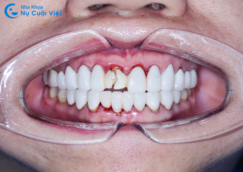 Nụ Cười Việt - Hậu quả bọc răng sứ giá rẻ: Nắm ngay để tránh ảnh hưởng đến sức khỏe răng miệng của bạn