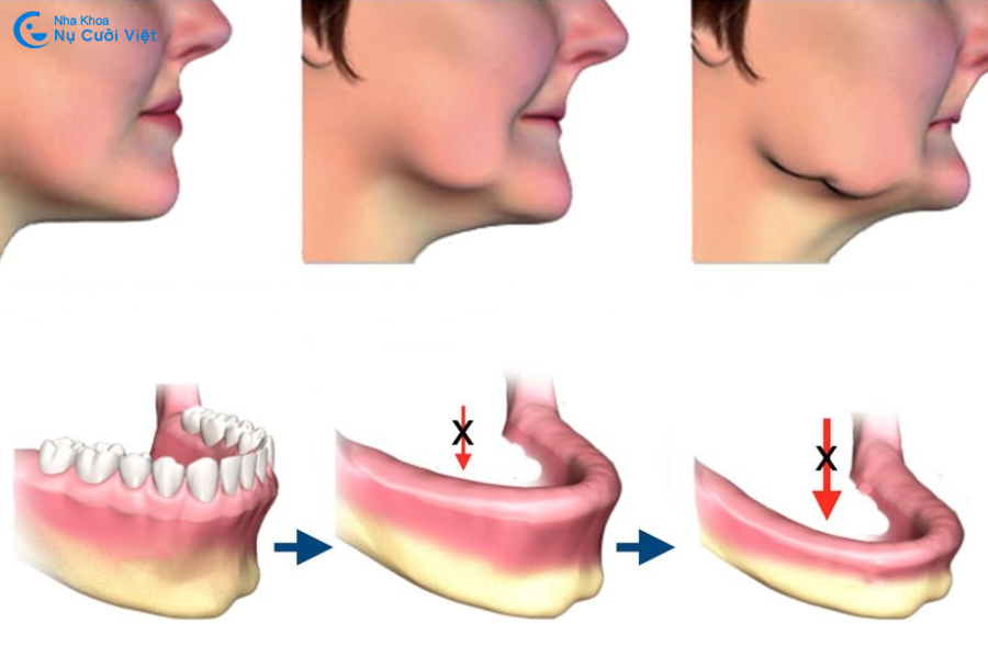 hậu quả mất răng số 7 gây tiêu xương hóp má
