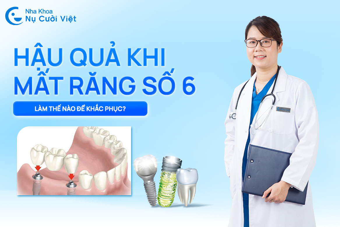 Nụ Cười Việt - HẬU QUẢ KHI MẤT RĂNG SỐ 6? CÁCH KHẮC PHỤC HIỆU QUẢ NHẤT HIỆN NAY?