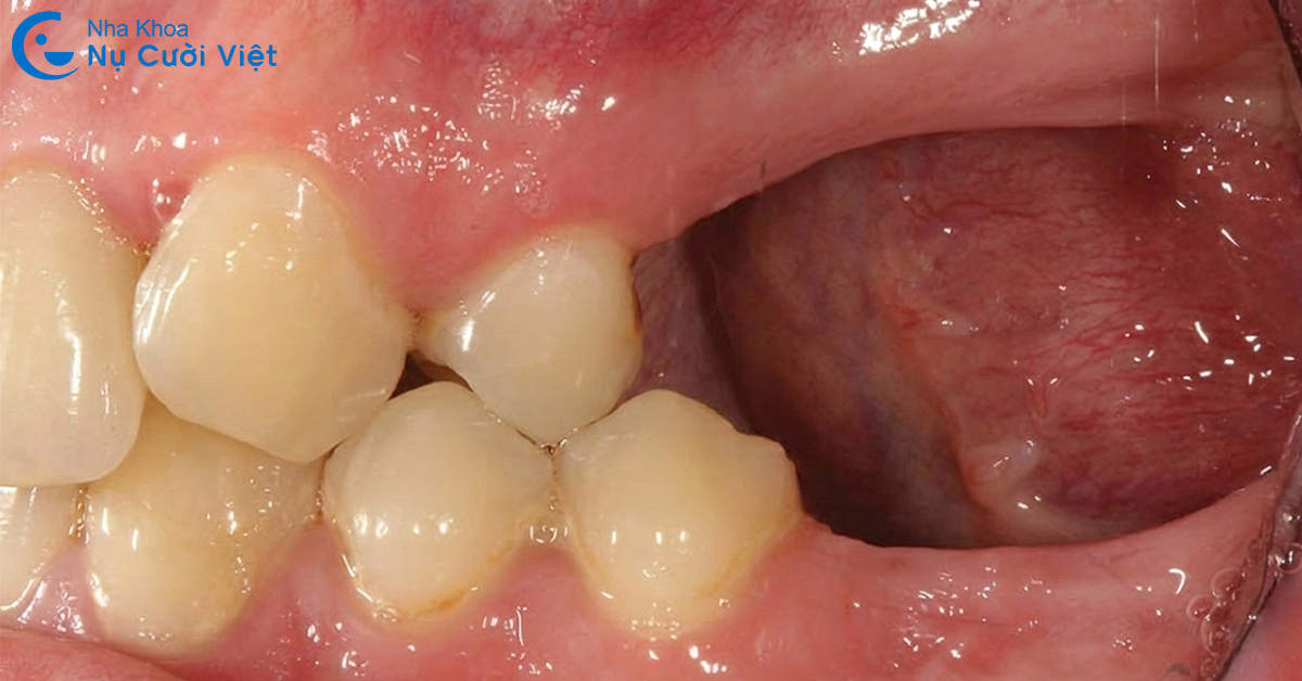 hậu quả mất răng tiêu xương hàm