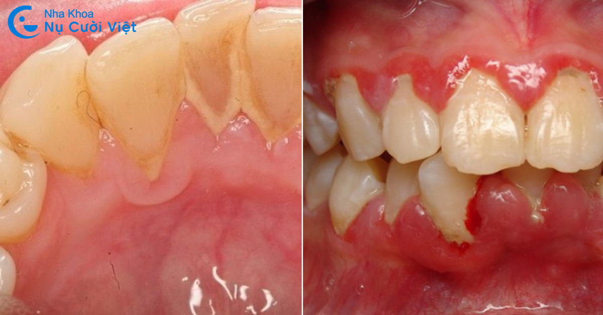 hậu quả của răng lộn xộn