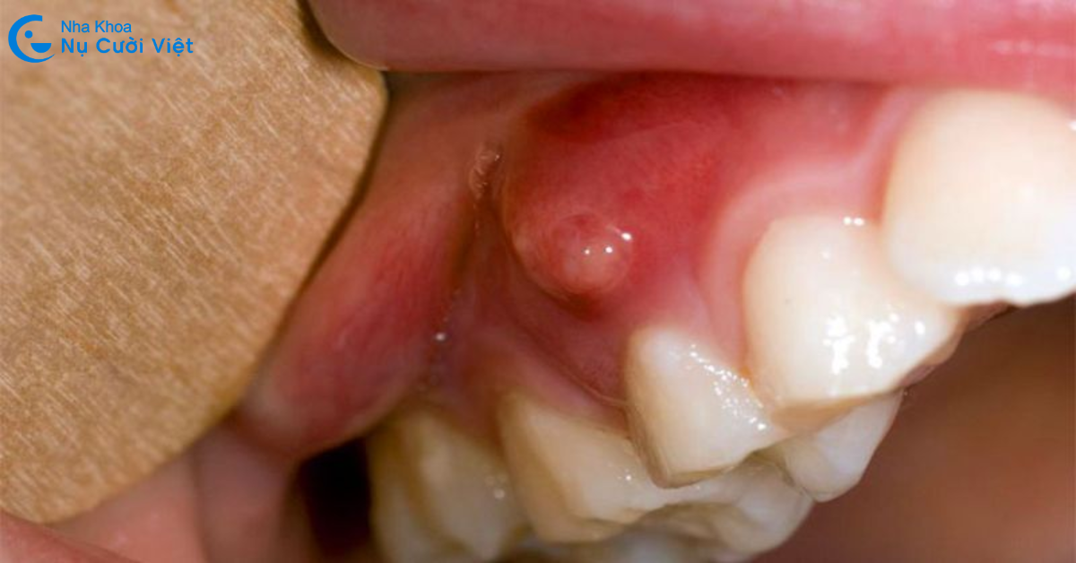 hậu quả của răng sâu vào tủy