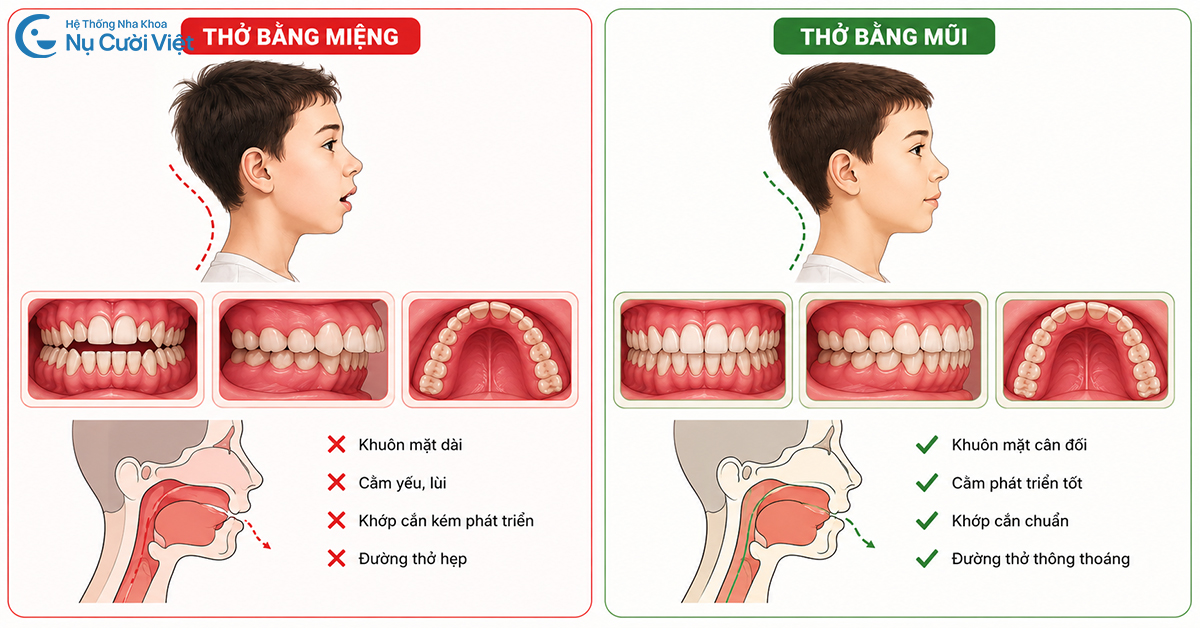 hậu quả của thở bằng miệng với trẻ em