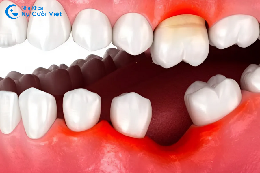 Nụ Cười Việt - HẬU QUẢ KHI MẤT RĂNG SỐ 6? CÁCH KHẮC PHỤC HIỆU QUẢ NHẤT HIỆN NAY?
