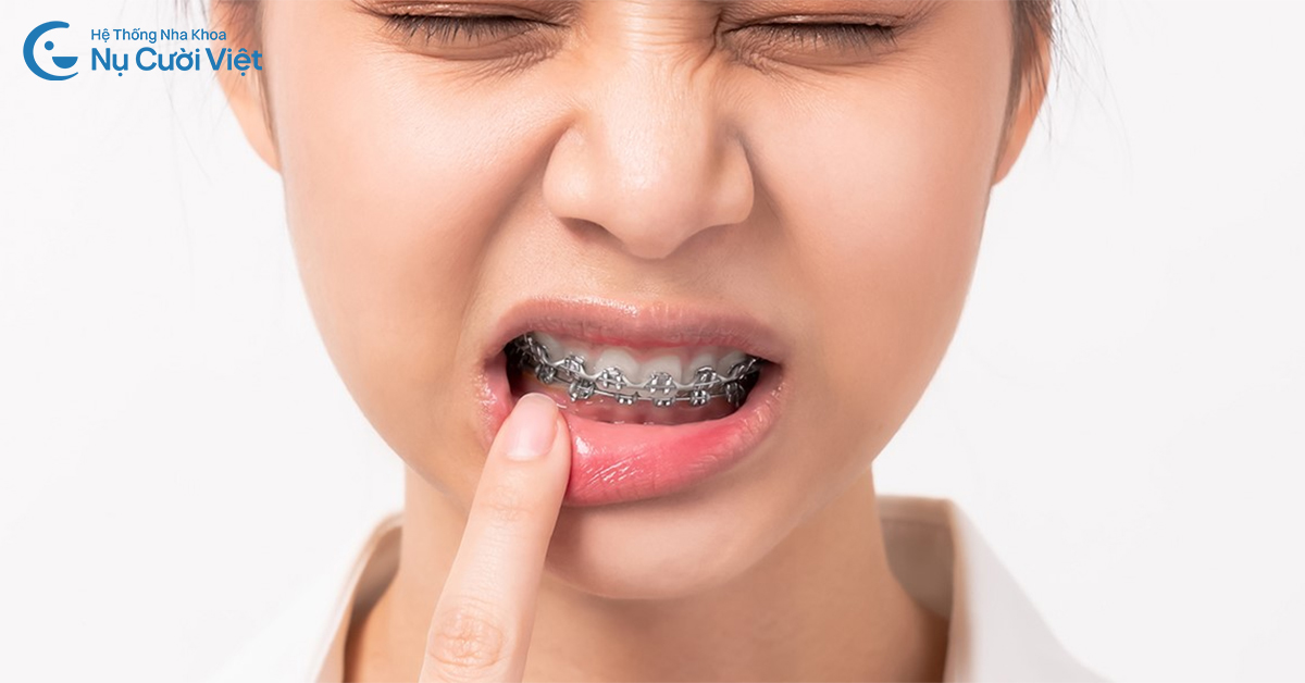 ảnh hưởng của viêm nướu khi niềng răng
