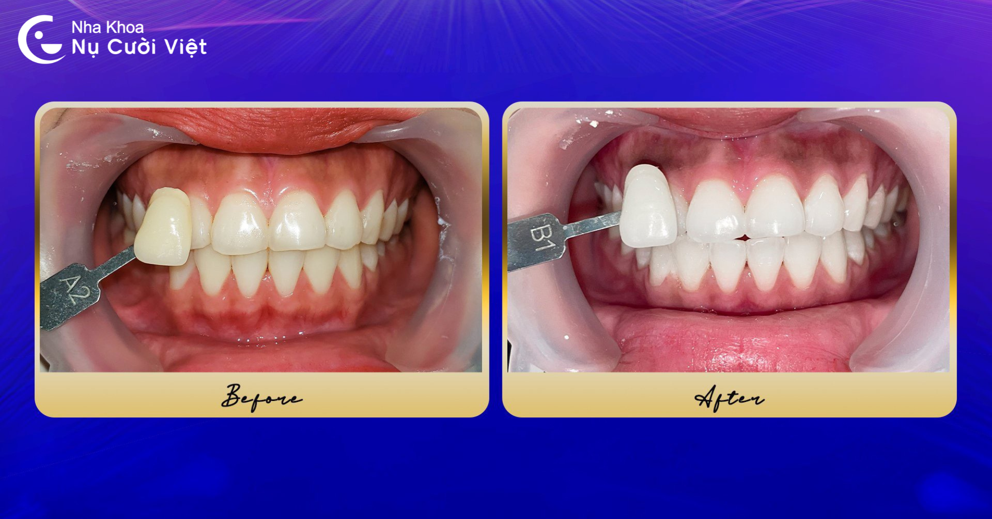 trước sua khi tẩy trắng răng bằng laser