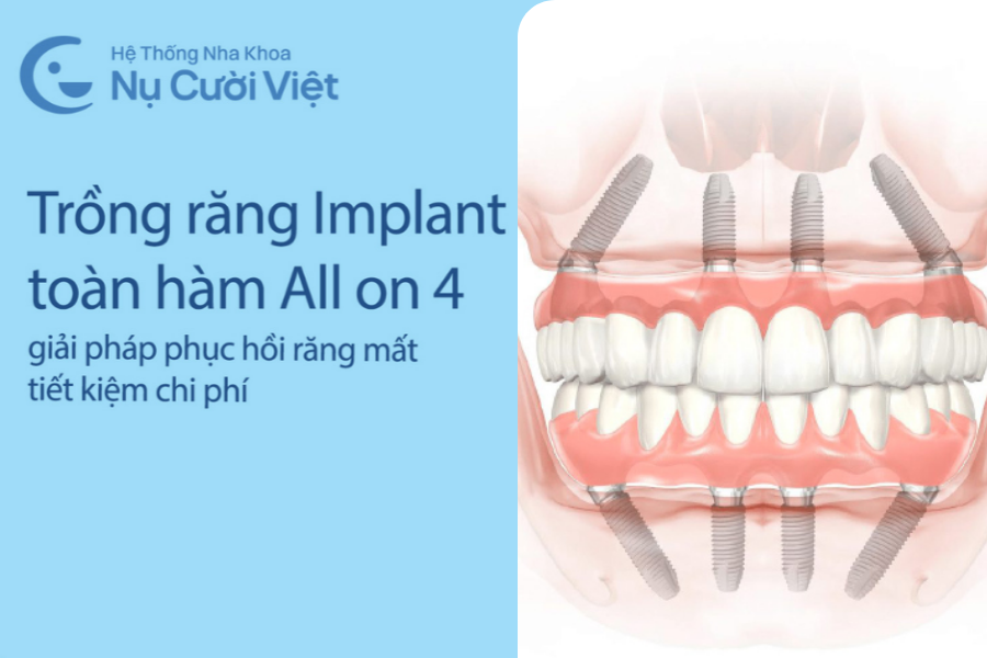 Nụ Cười Việt - Trồng răng toàn hàm All-on-4: Giải pháp phục hồi tiết kiệm chi phí cho người mất răng toàn hàm