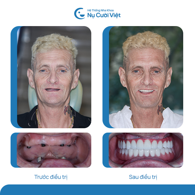 trồng răng implant tại nụ cười việt