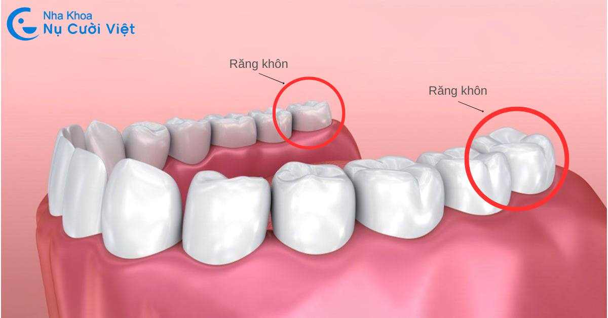 không nhổ răng khôn có sao không
