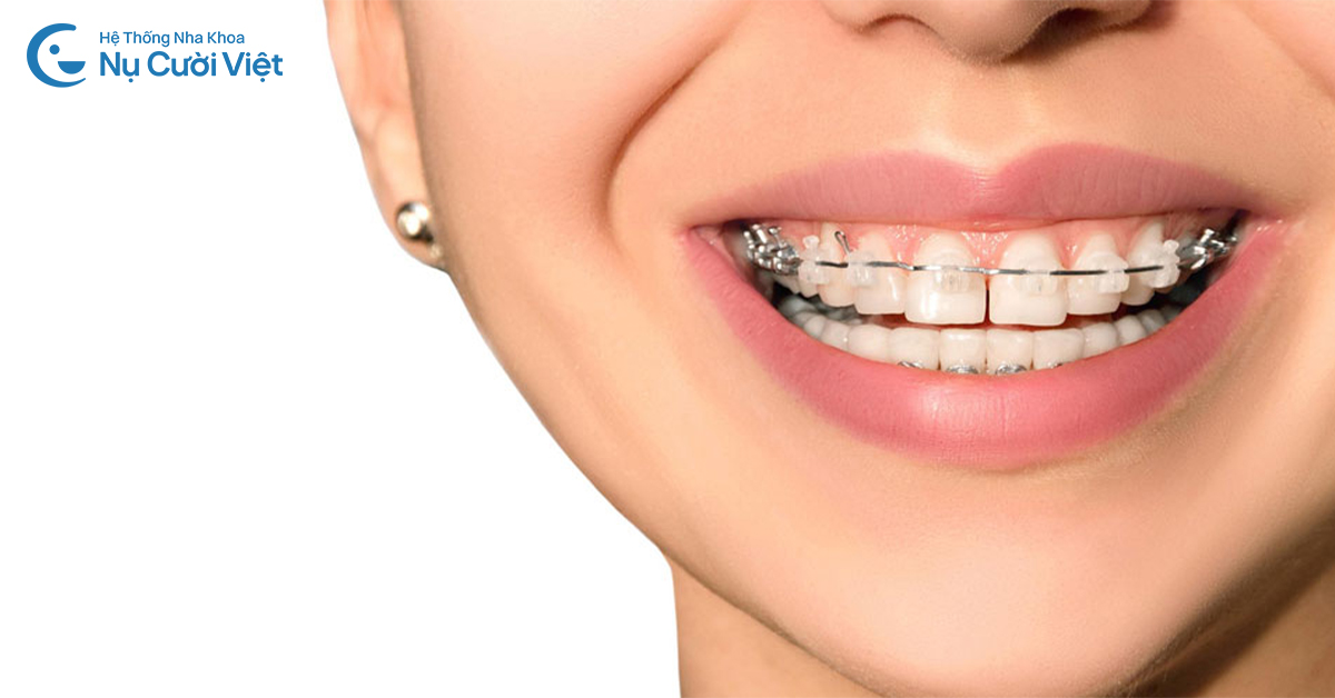 làm khít răng thưa bằng niềng răng