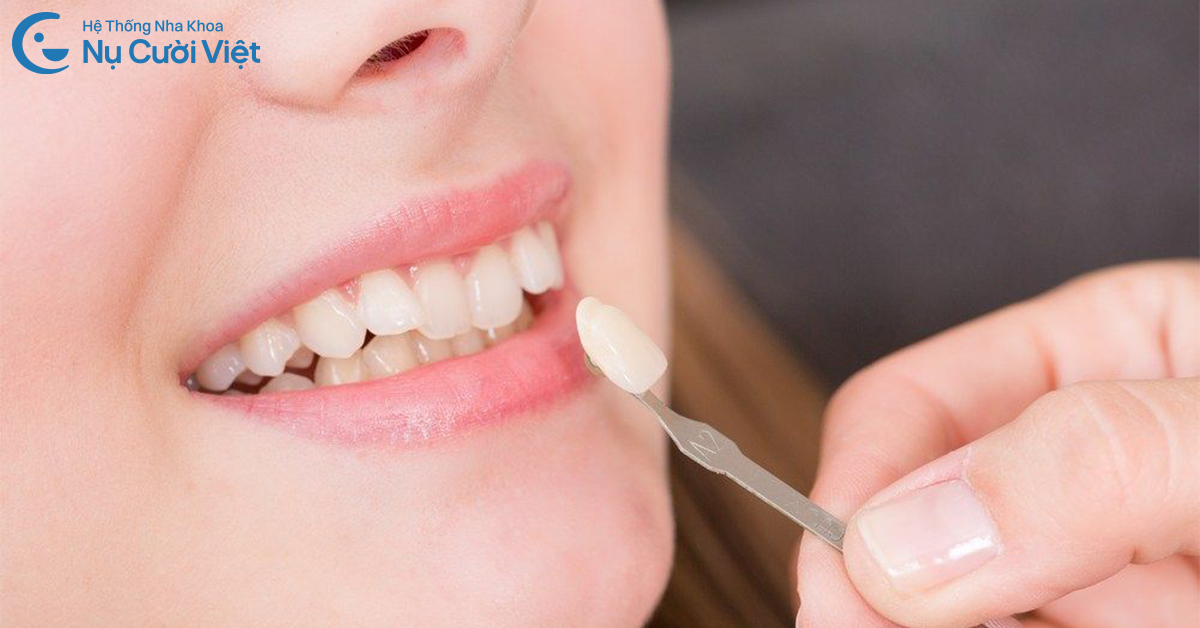 làm răng sứ ăn tết khi nào hợp lý