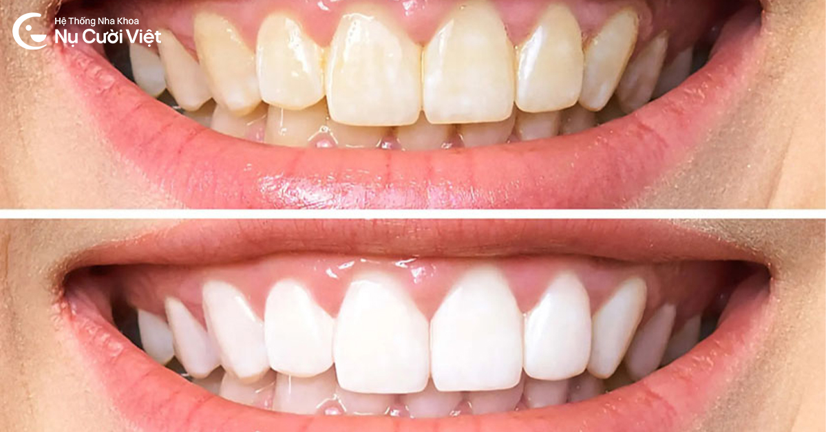 nên làm gì khi răng sứ bi xuống màu