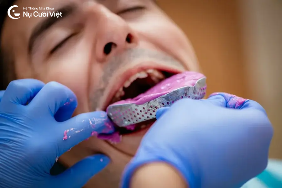 lấy dầu implant bằng bột thạch cao