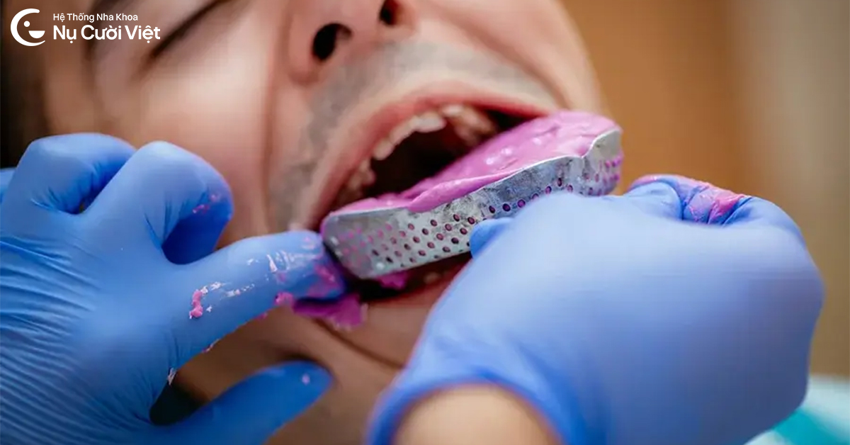 lấy dấu răng truyền thống khi niềng răng