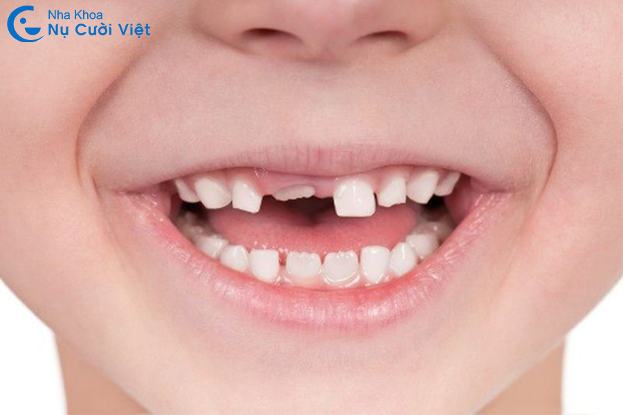 Nụ Cười Việt - Lịch thay răng sữa ở trẻ: Cha mẹ cần biết để chăm sóc đúng cách