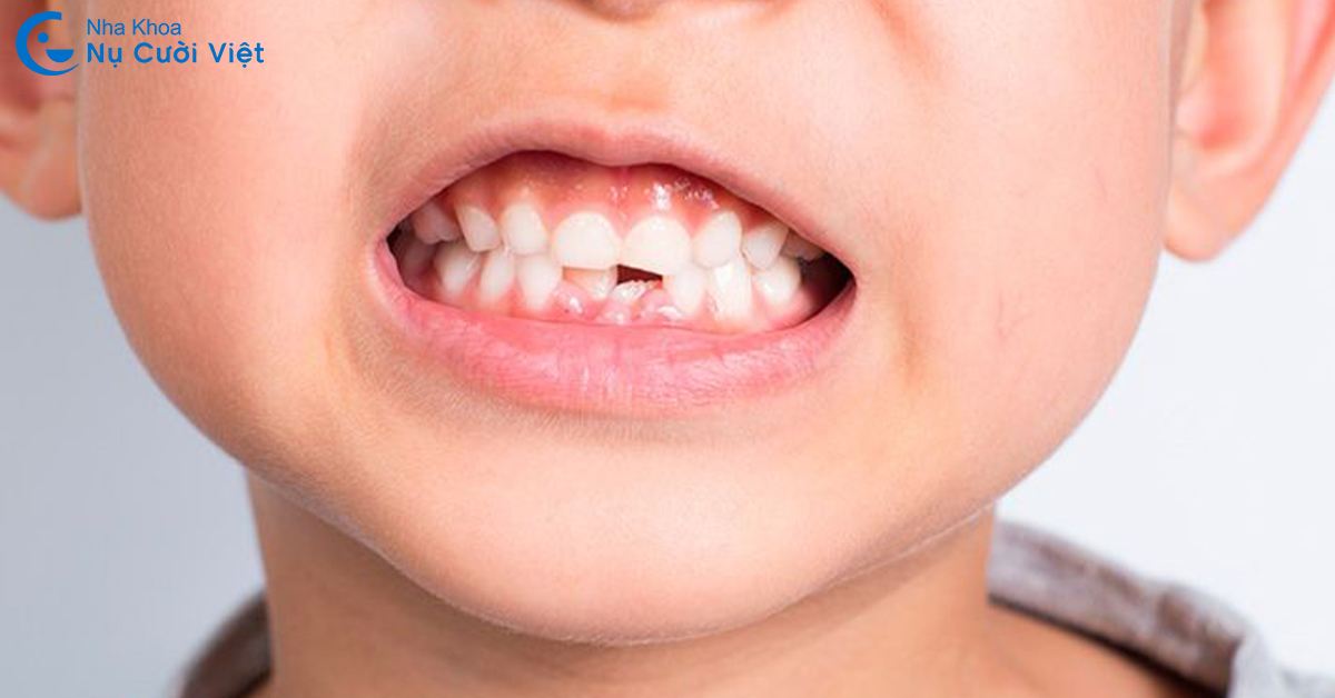 lịch thay răng sữa cho bé