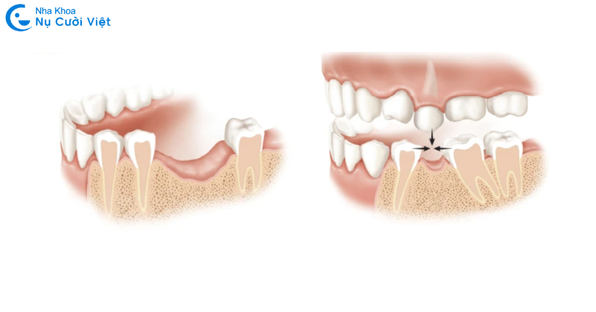loãng xương có ảnh hưởng đến cấy ghép implant không