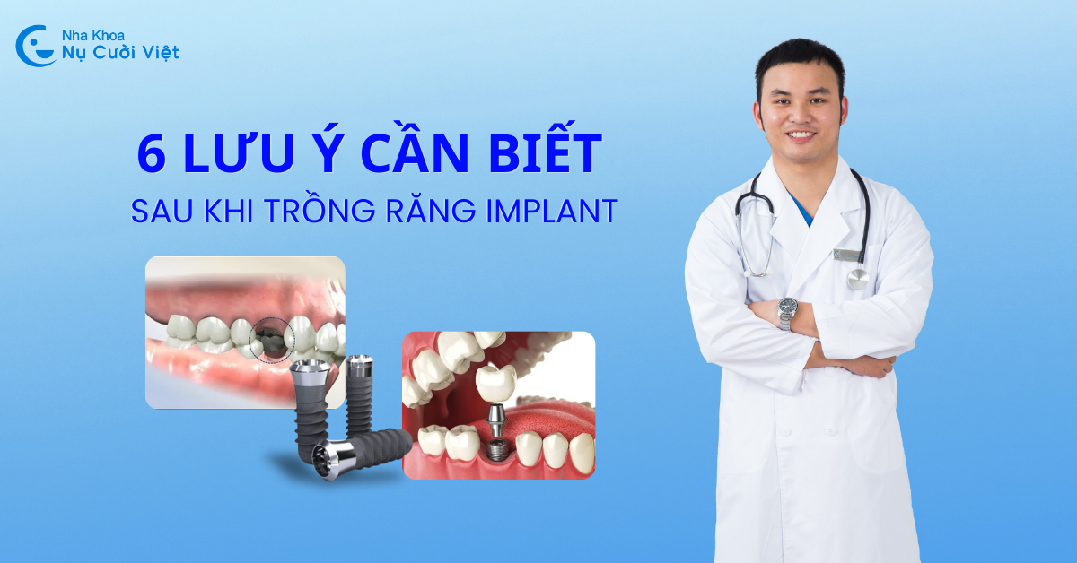 lưu ý sau khi trồng răng implant