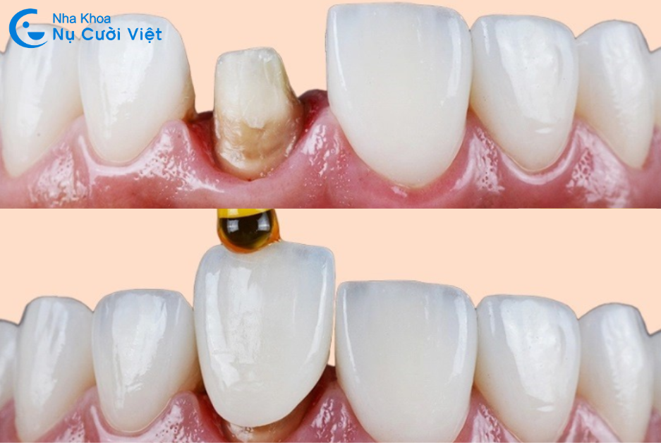 Nụ Cười Việt - Mài răng bọc sứ có làm răng thật yếu đi không, có đau không?