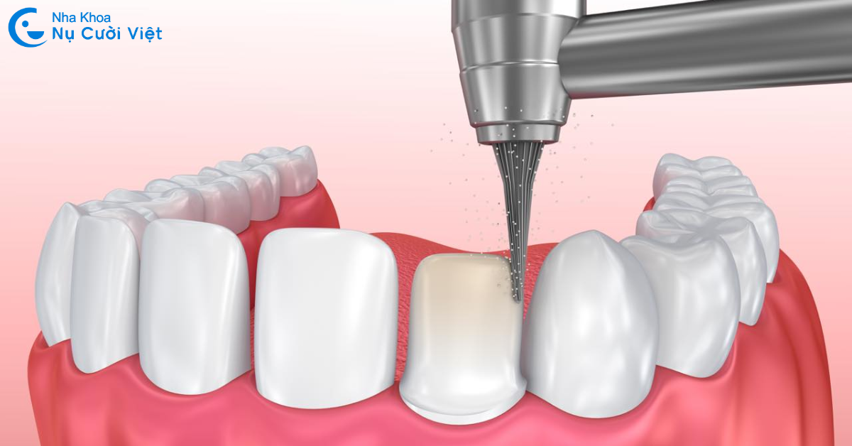 mài răng bọc sứ có ảnh hưởng gì không