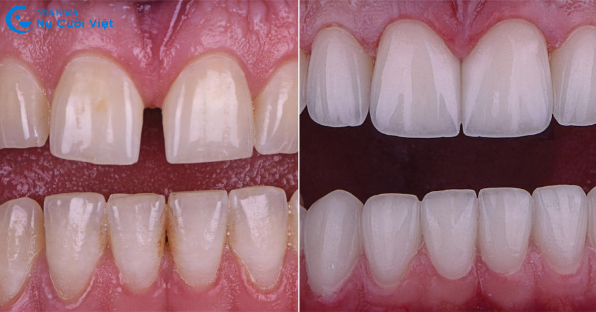 mài răng để dán sứ veneer