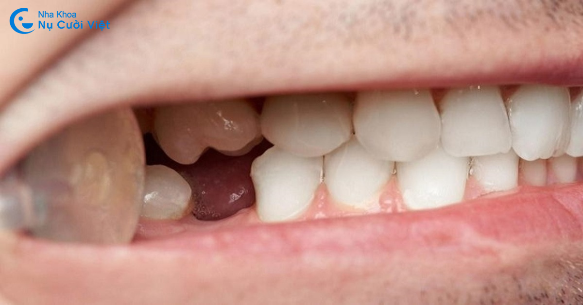 mất răng vẫn niềng lại được