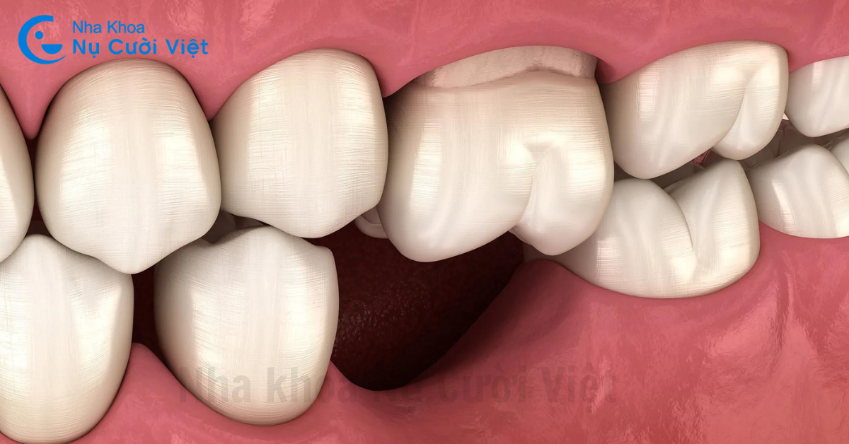 mất răng gây nên nhiều hậu quả đến thẩm mỹ và chức năng ăn nhai