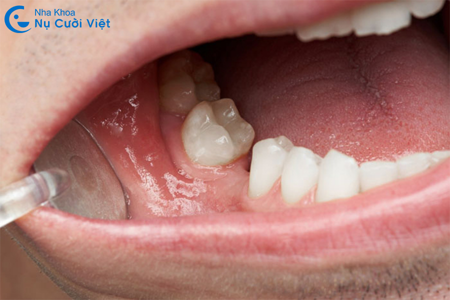 Nụ Cười Việt - MẤT RĂNG HÀM CÓ BỊ HÓP MÁ KHÔNG? NGUYÊN NHÂN VÀ CÁCH KHẮC PHỤC HIỆU QUẢ?