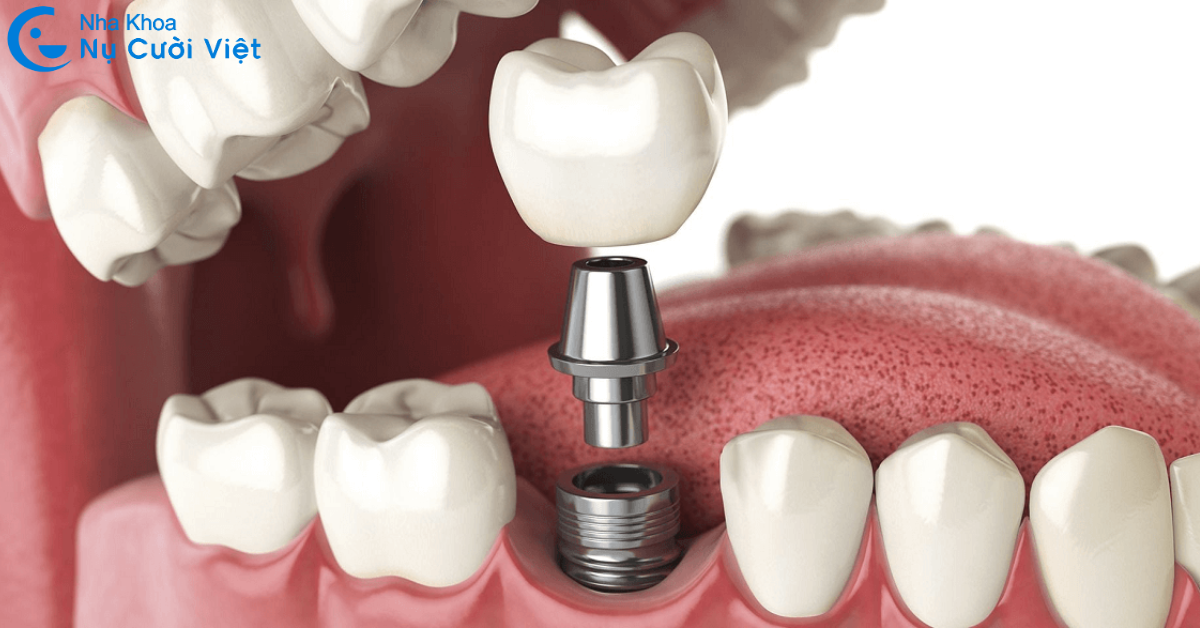 mất răng hàm trồng răng implant