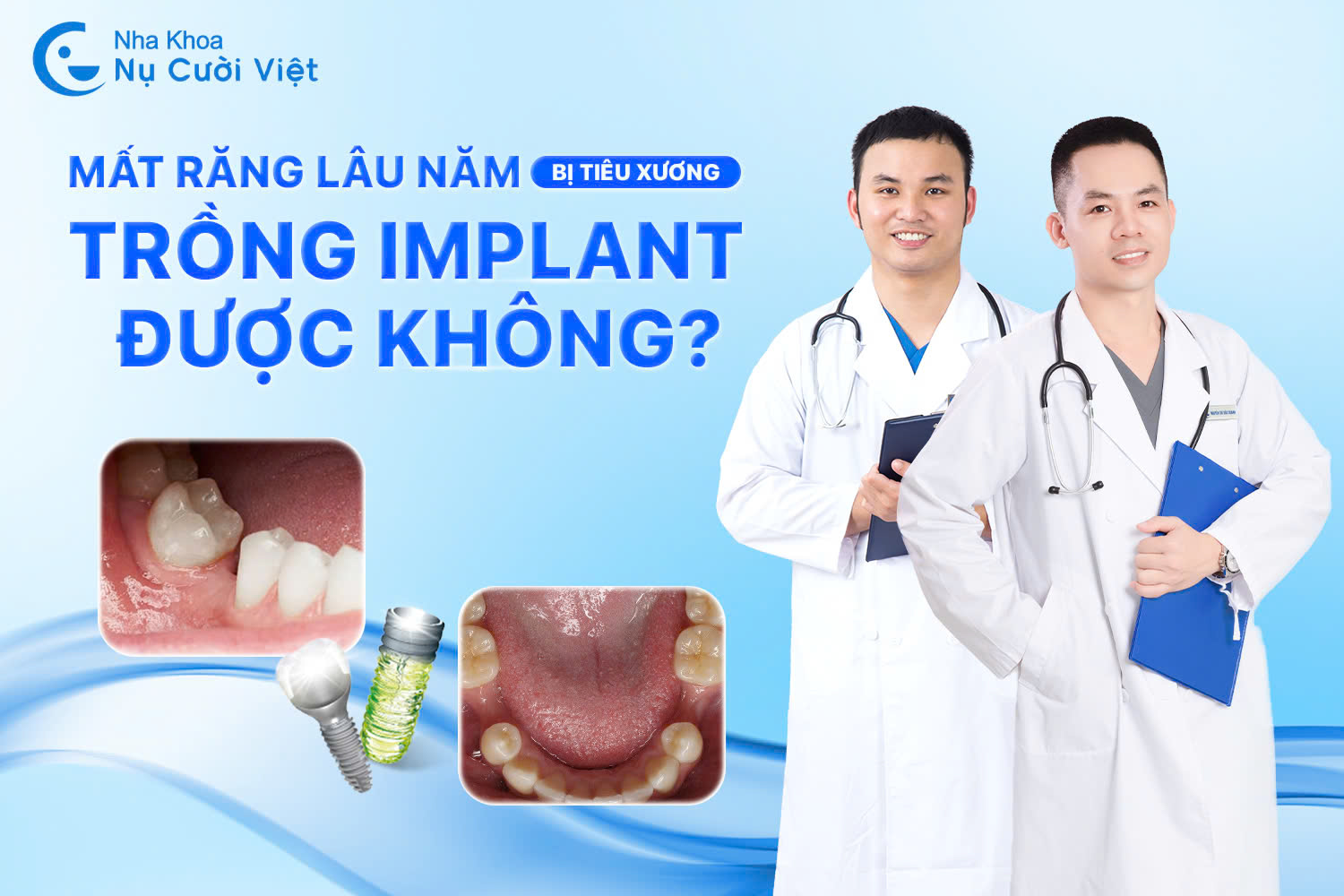 Mất răng lâu năm có trồng Implant được không? Chi phí bao nhiêu?
