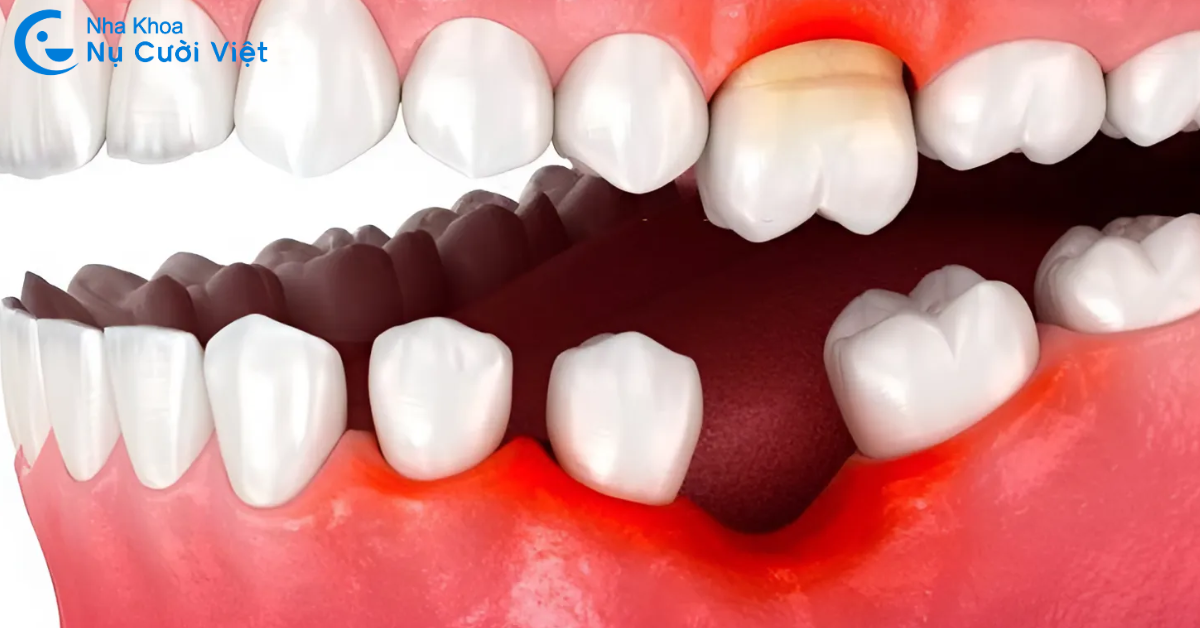 trường hợp cần ghép xương khi cấy ghép implant