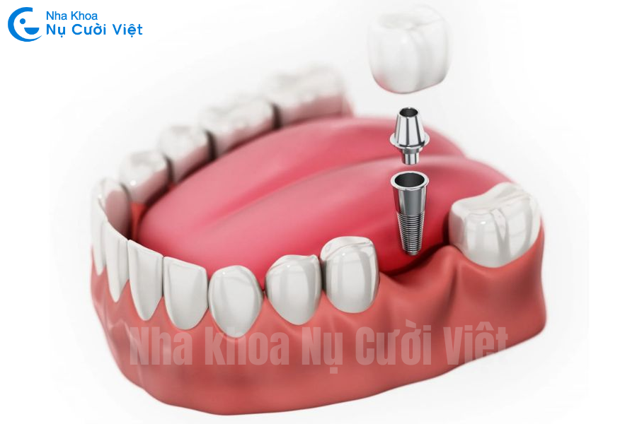 Nụ Cười Việt - MẤT RĂNG SỐ 7 HÀM DƯỚI CÓ NGUY HIỂM KHÔNG? CẢNH BÁO 5 ẢNH HƯỞNG NGHIÊM TRỌNG VÀ GIẢI PHÁP ĐIỀU TRỊ HIỆU QUẢ