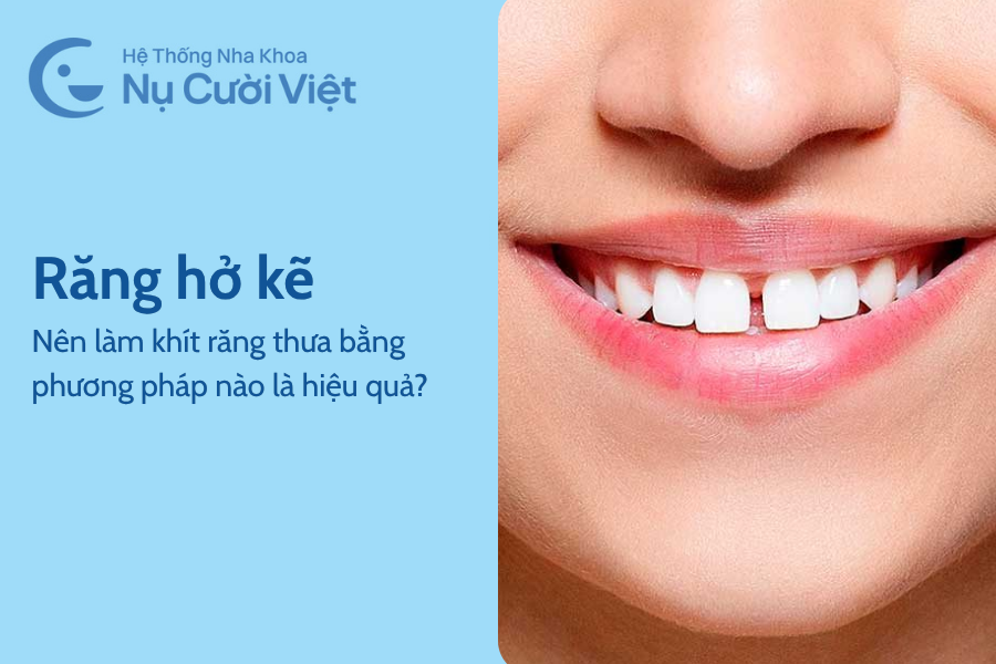 Nụ Cười Việt - Răng hở kẽ, nên làm khít răng thưa bằng phương pháp nào là hiệu quả?