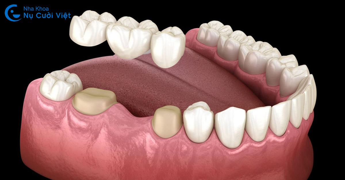 người già mất răng làm cầu răng sứ