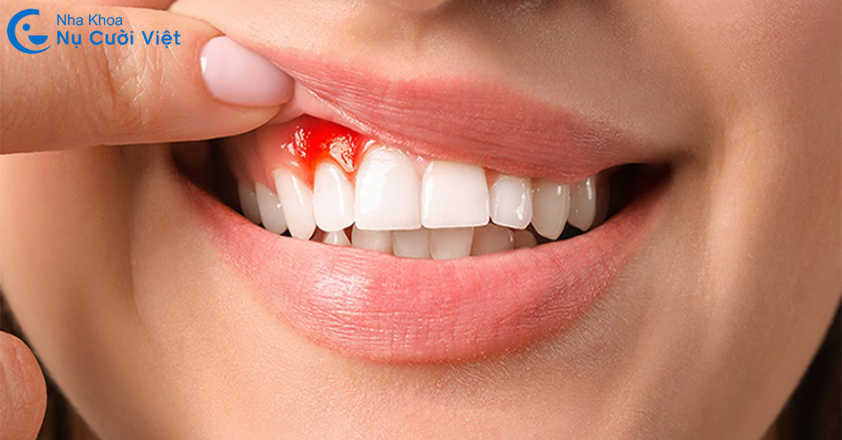 nguyên nhân chảy máu chân răng khi đánh răng
