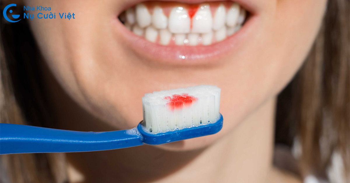 đánh răng sai cách gây chảy máu chân răng