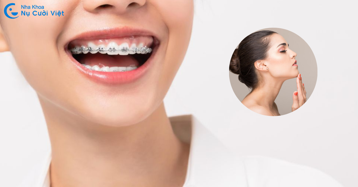 nguyên nhân gây cằm lẹm