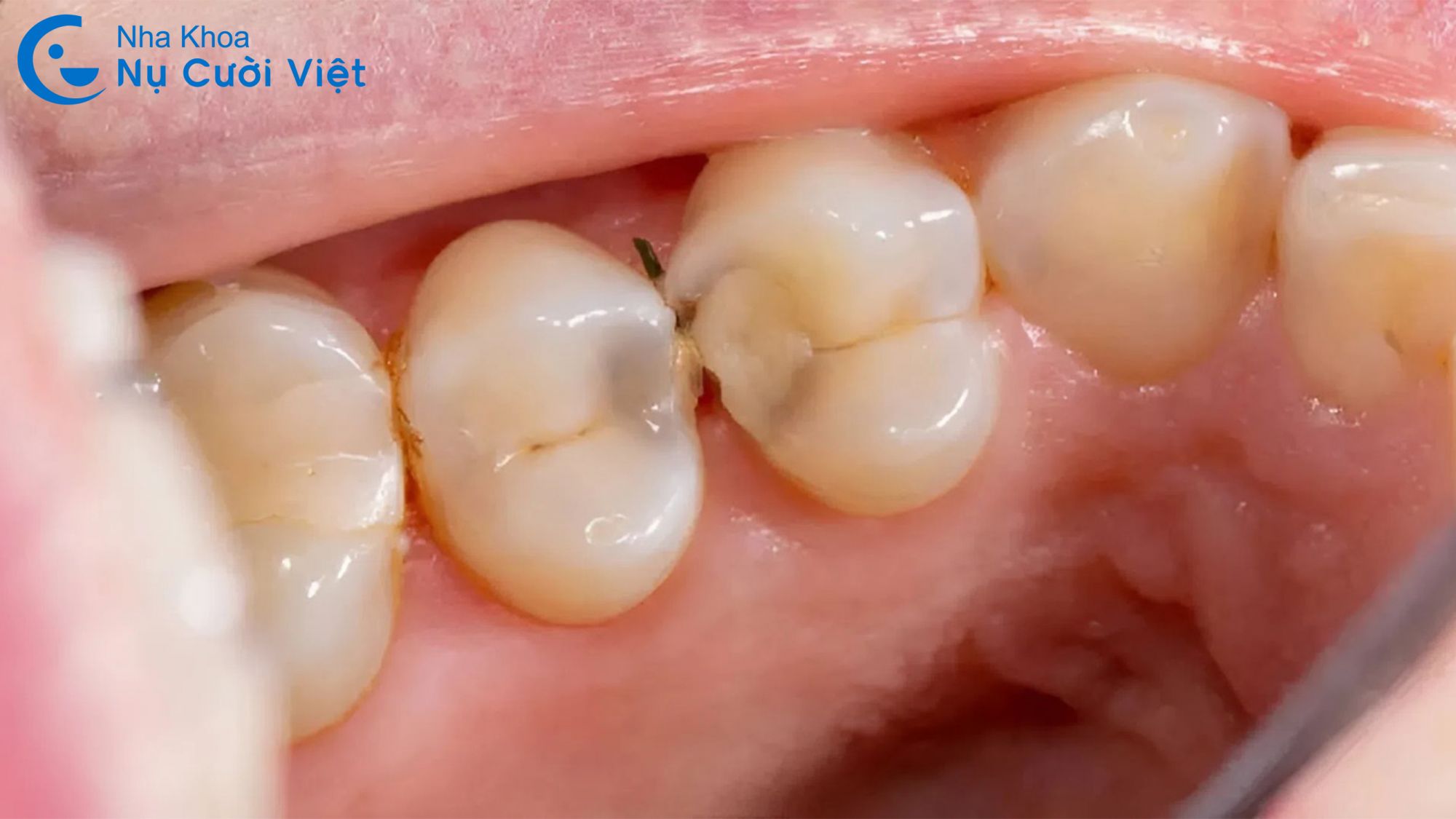 sâu răng là một trong những nguyên nhân gây răng bị đen ở kẽ