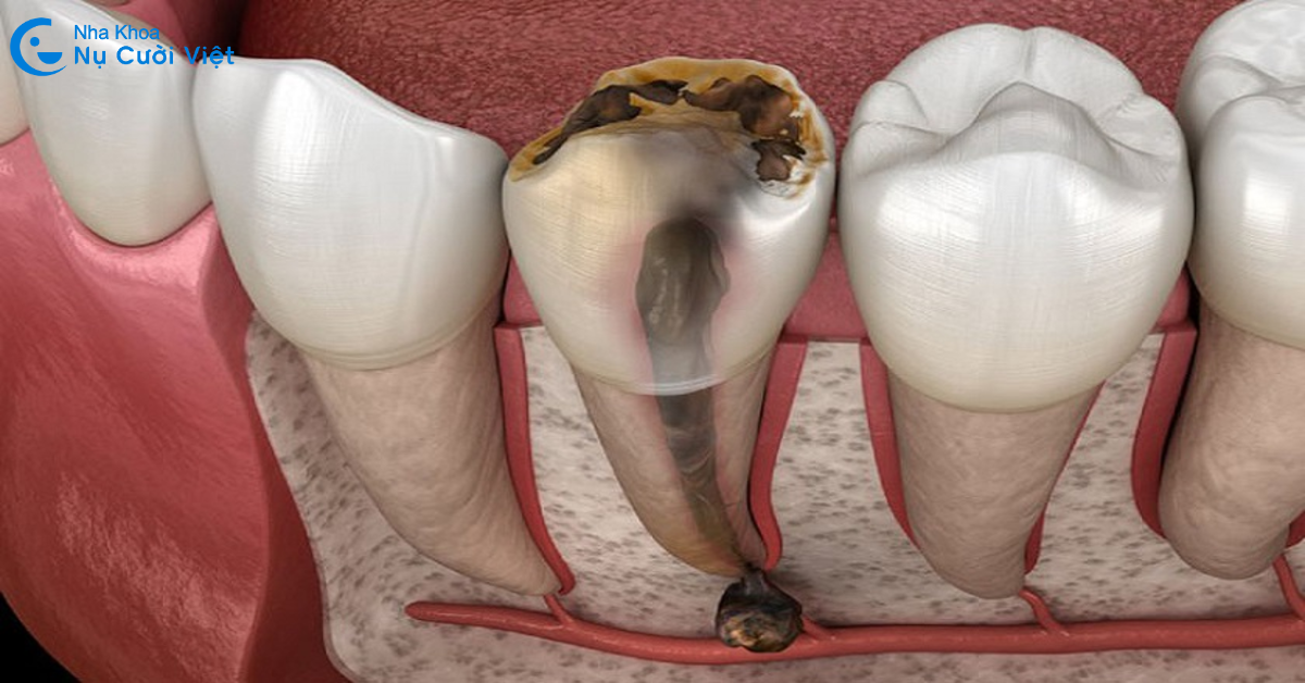 dấu hiệu nhận biết răng sâu vào tủy