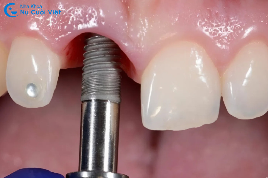 Nụ Cười Việt - NỖI LO TRỤ IMPLANT BỊ ĐÀO THẢI - NGUYÊN NHÂN, DẤU HIỆU VÀ CÁCH KHẮC PHỤC HIỆU QUẢ