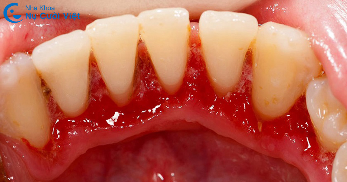 nguyên nhân gây tụt lợi hở chân răng