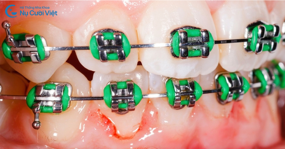 viêm nướu khi niềng răng là gì nguyên nhân