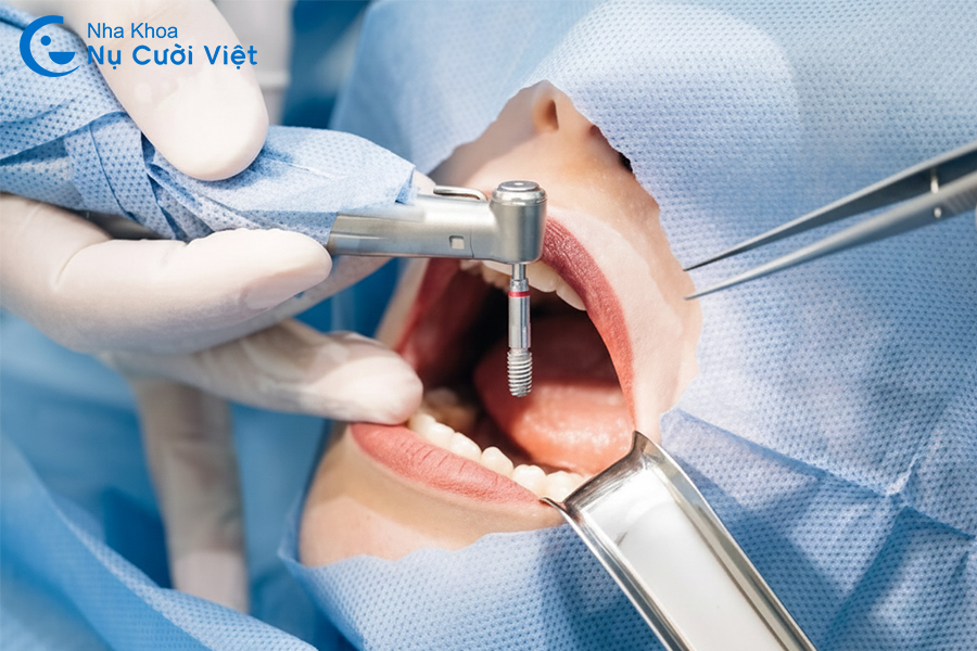 Nụ Cười Việt - Nhổ răng xong bao lâu thì trồng lại được? Nếu không trồng thì có sao không?