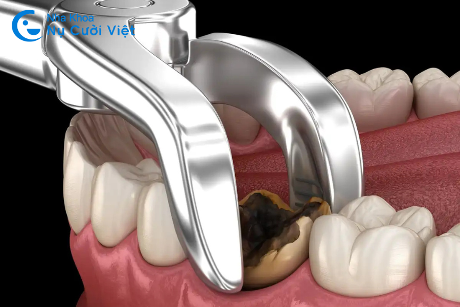 Nụ Cười Việt - Nhổ răng hàm dưới có nguy hiểm không? Trường hợp nào nhất định phải nhổ bỏ