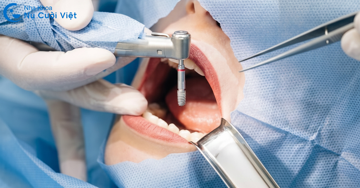 nhổ răng bao lâu thì trồng được implant