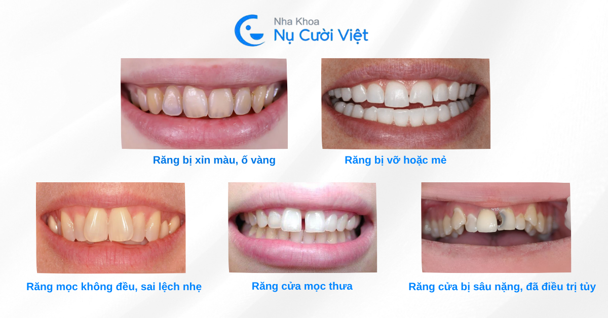 những trường hợp nên bọc sứ 2 răng cửa