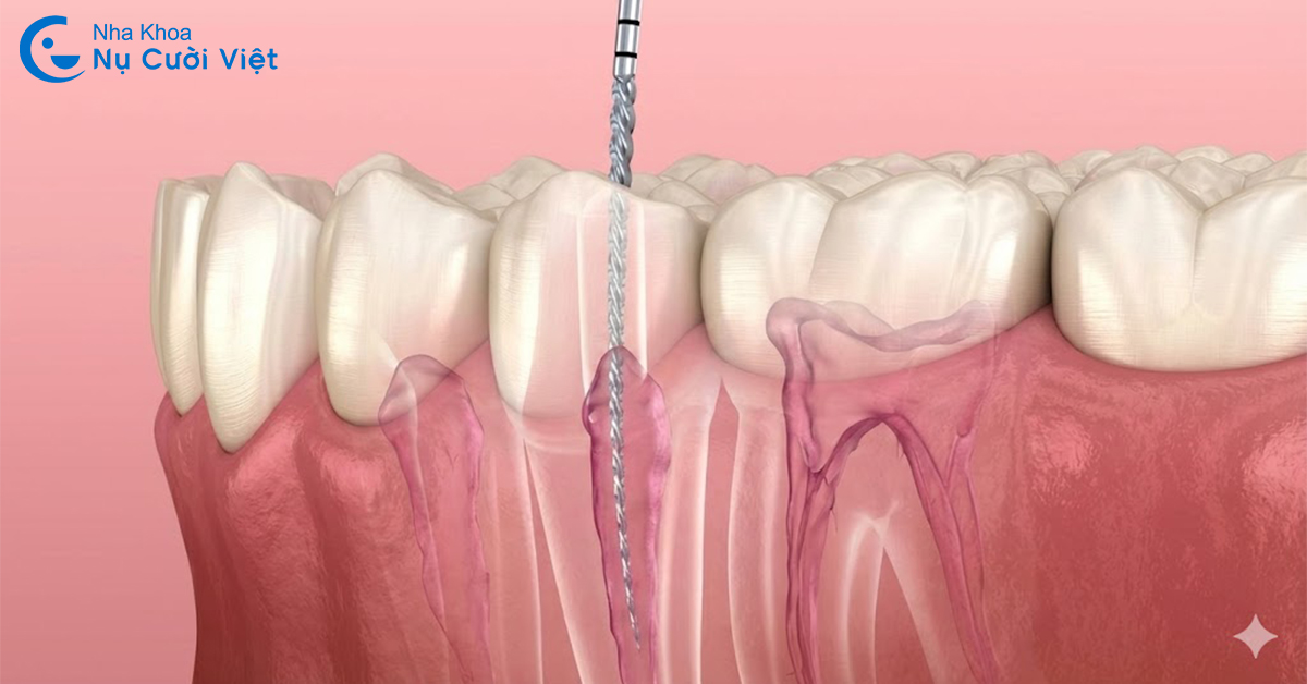 những trường hợp phải lấy tủy răng