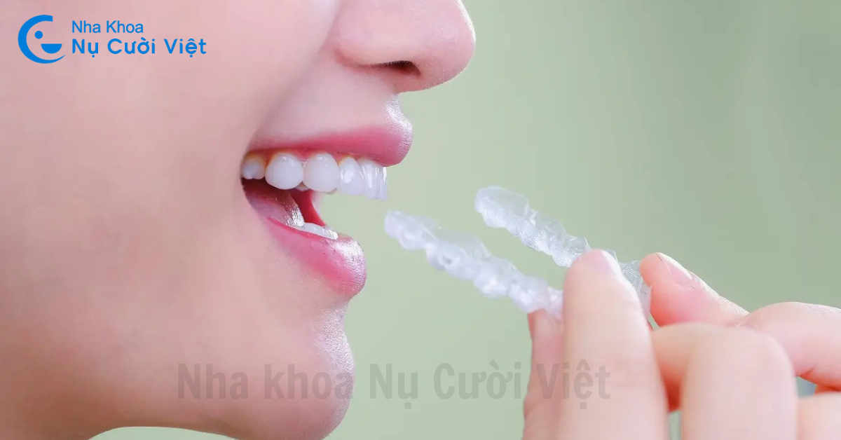 niềng 2 răng cửa với niềng răng Invisalign