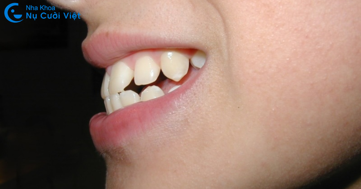 chỉ niềng 2 răng cửa bị hô có được không